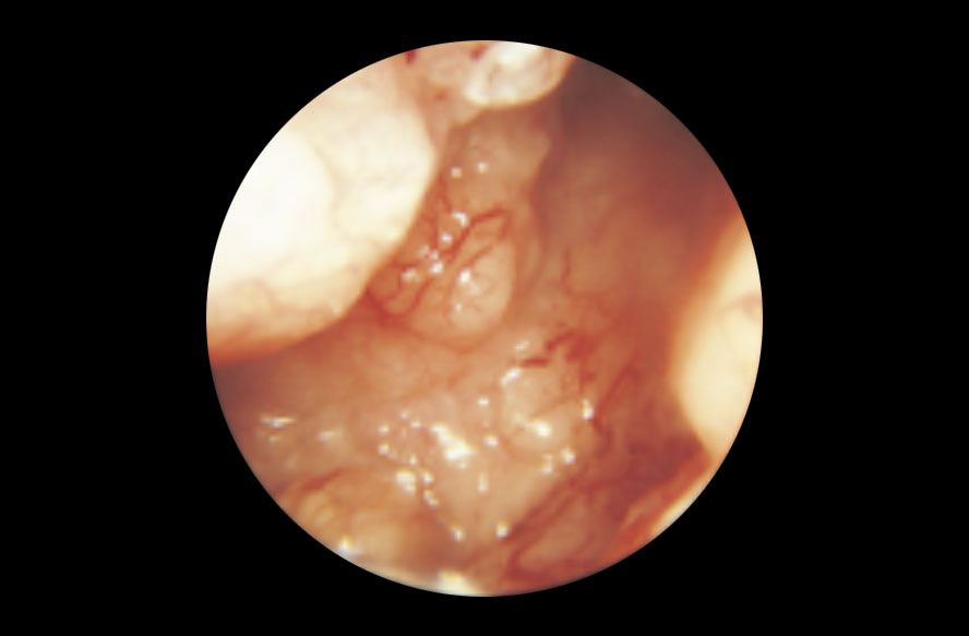 Histeroscopia - Cáncer de endometrio Imagen de la camara de un histeroscopio que muestra un cancer de endometrio