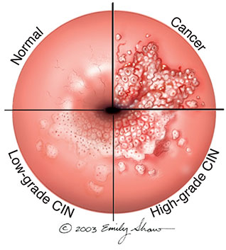 Evolución neoplasia cervical