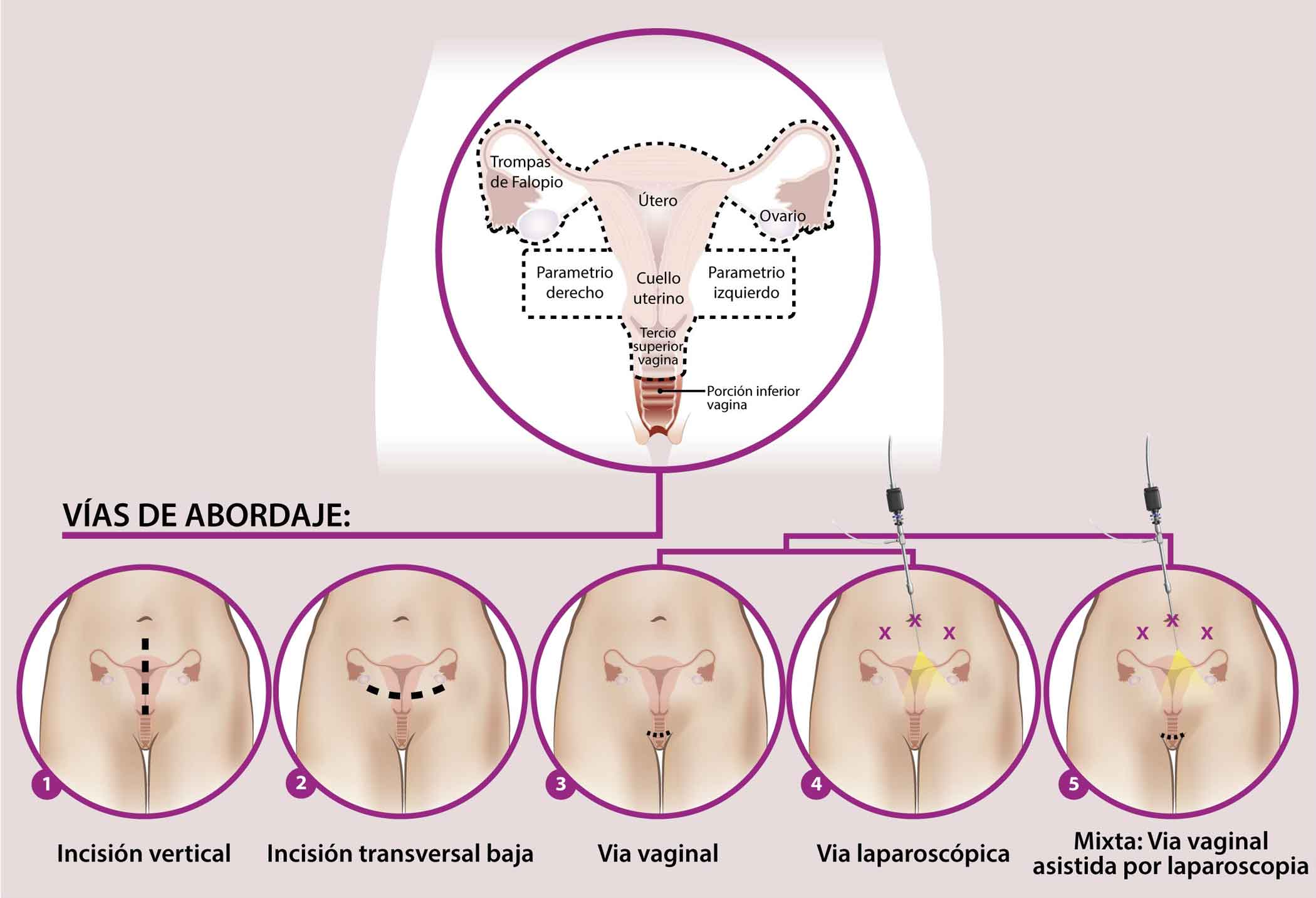 histerectomia_radical-vias_de_abordaje