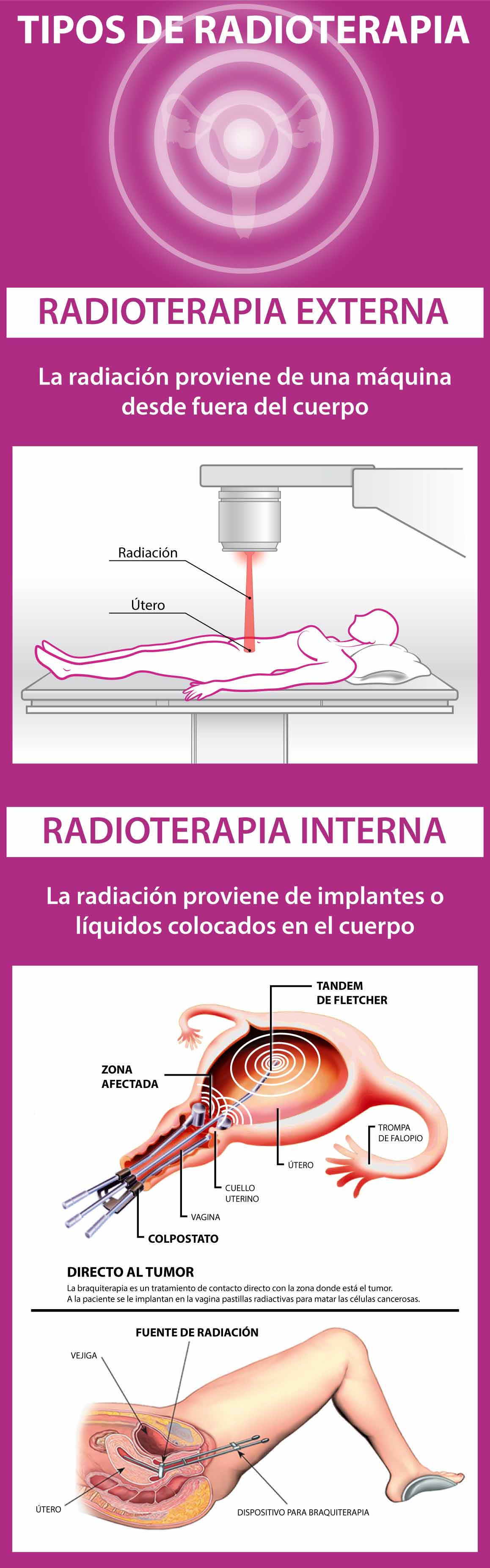 Radioterapia interna (braquiterapia) y radioterapia externa