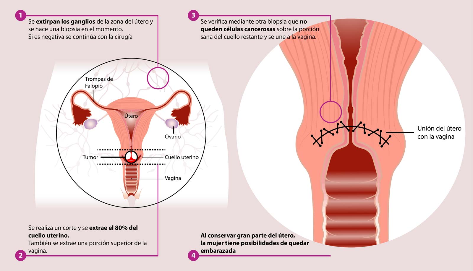 traquelectomia proceso